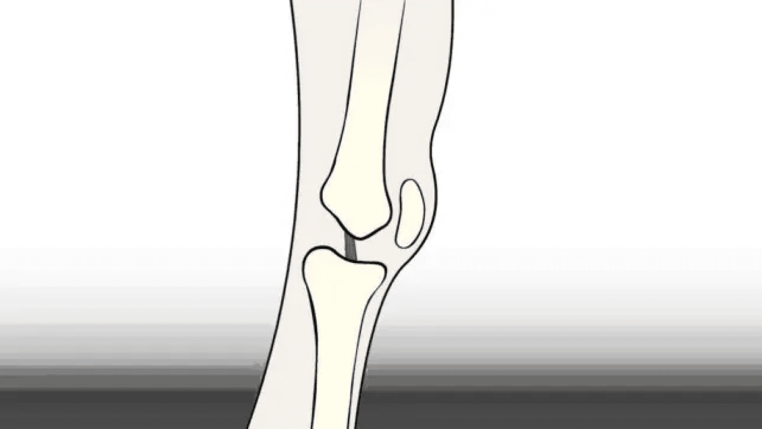ACL Tears